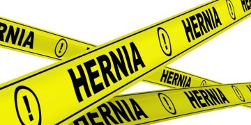Why Hernia Mesh Lawsuits Are Increasing In 2025